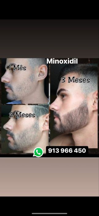 Minoxidil Foligain/kirkland extra forte