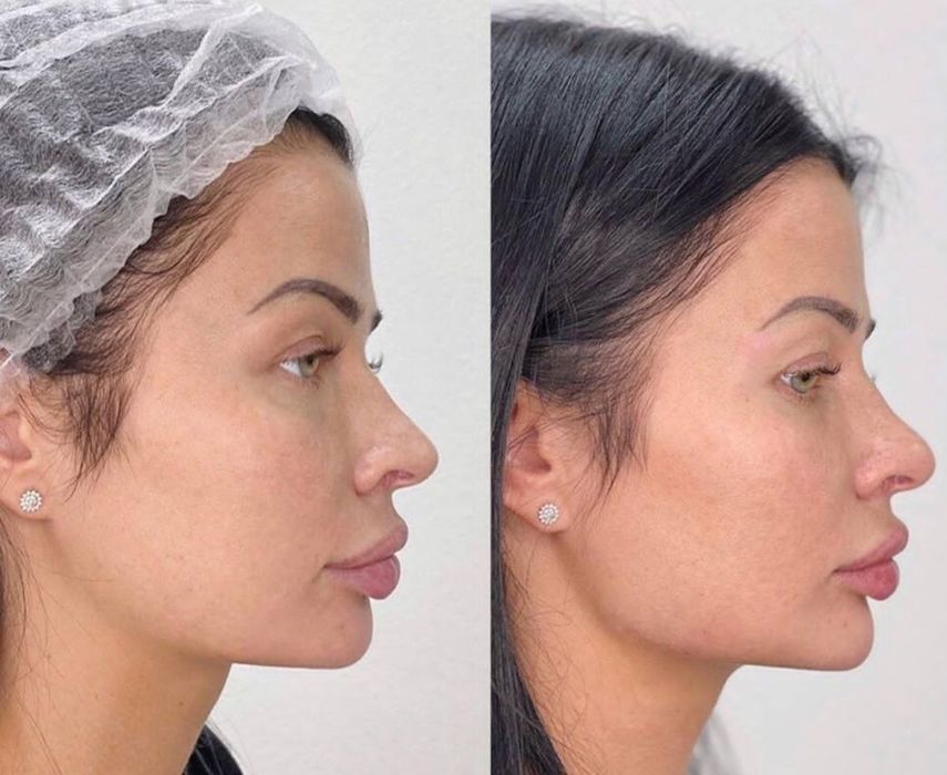 Косметолог. Губы . подбородок, углы нижней челюсти. Углы Джоли.