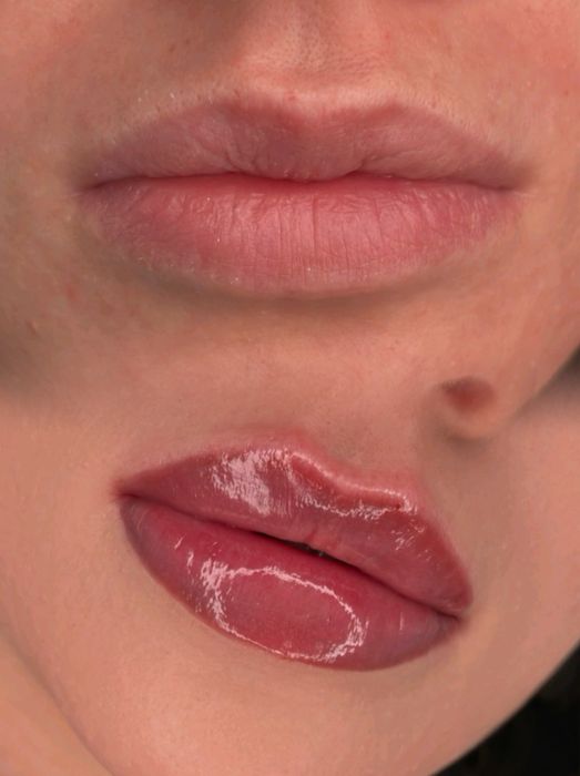 Збільшення губ, Контурна пластика, увеличение губ. Губы Киев