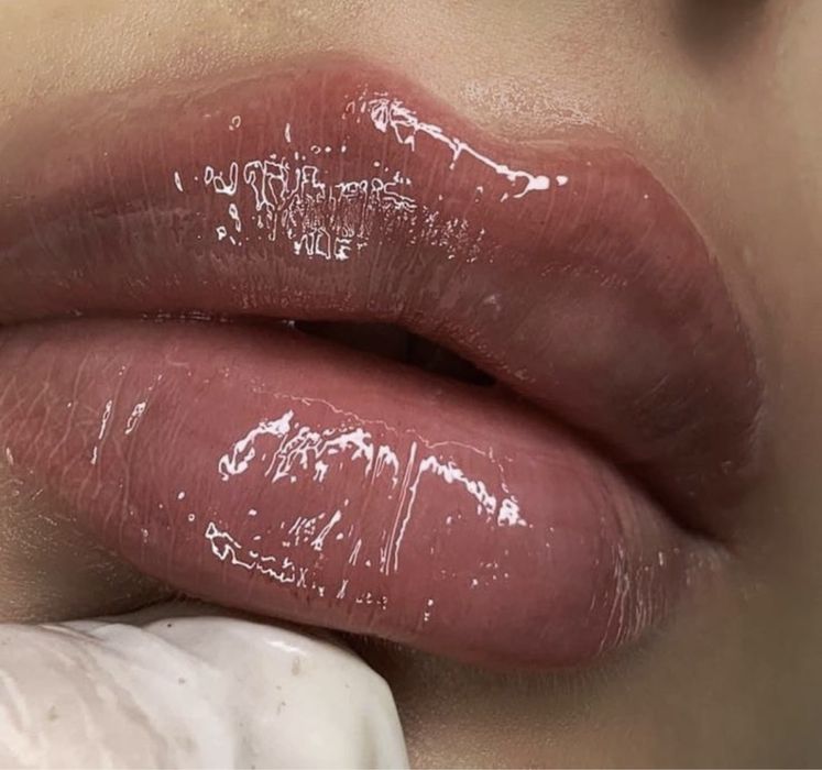 Збільшення губ троєщина 2000-1мл