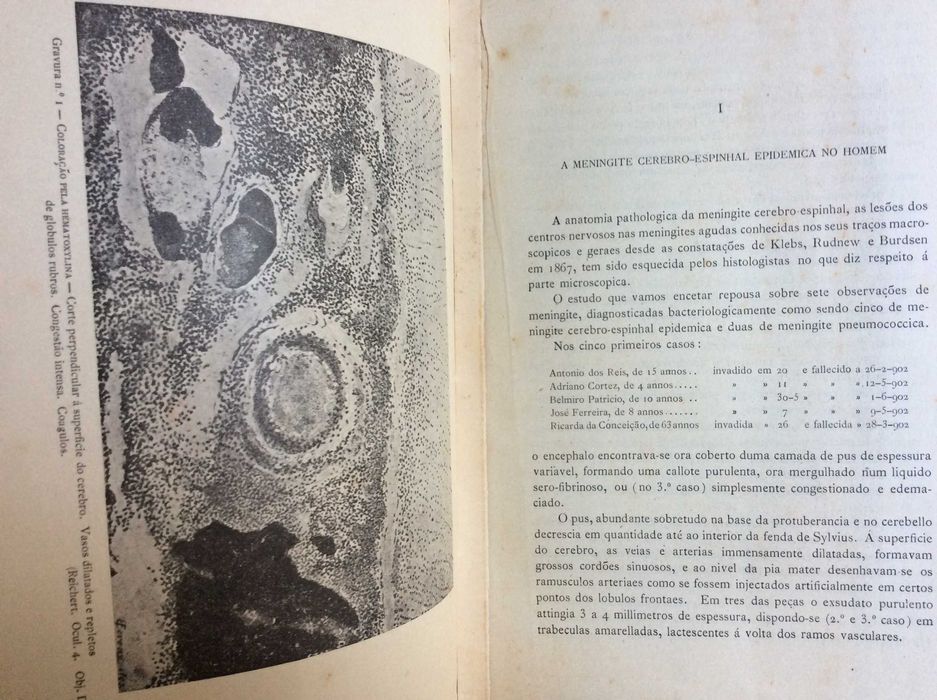 As alterações dos centros nervosos na meningite...1903