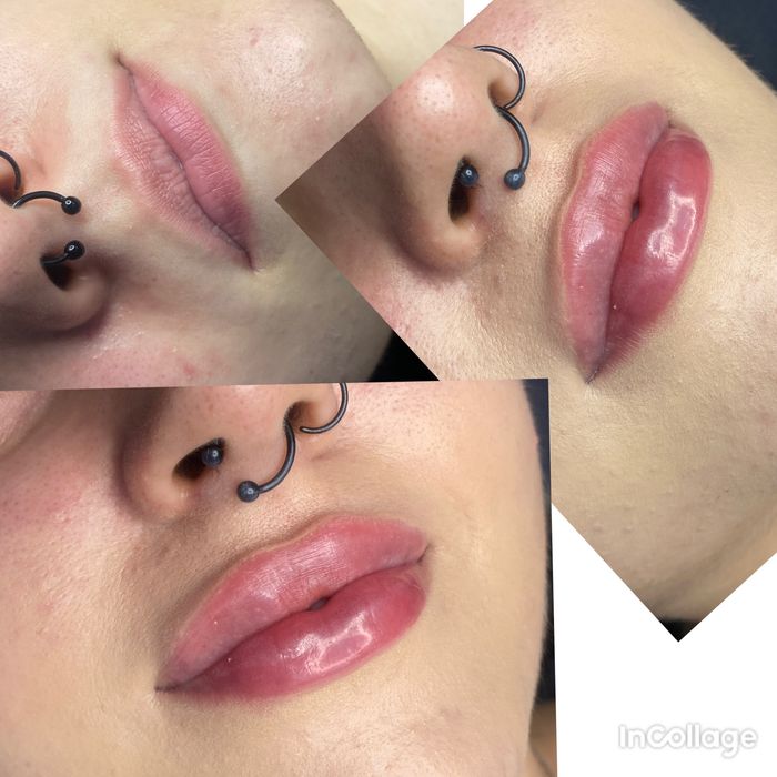 Modelowanie ust, botox ,nici, stymulatory, lipoliza !