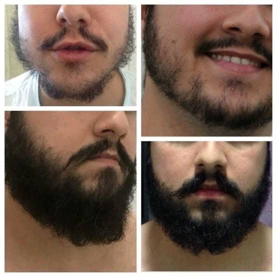 Minoxidil foligain / kirkland -fim da calvicie/ crescimento barba