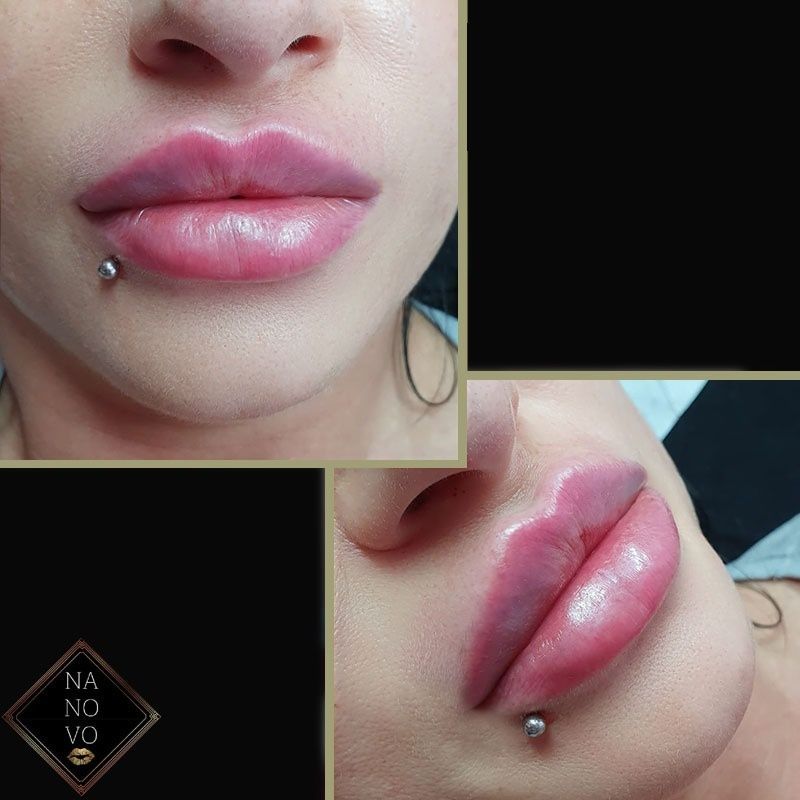BOTOX DAY 2024 WOLUMETRIA Zabiegi Medycyny Estetycznej Łódź Górna • OLX.pl