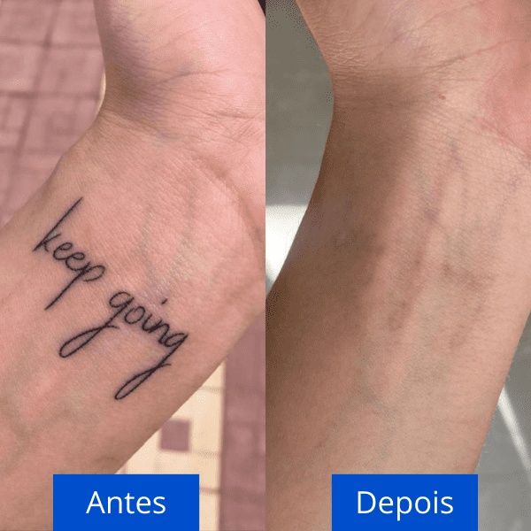 Vendo máquina de laser 3 ondas