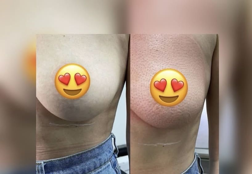 Безоперационная Блефаропластика