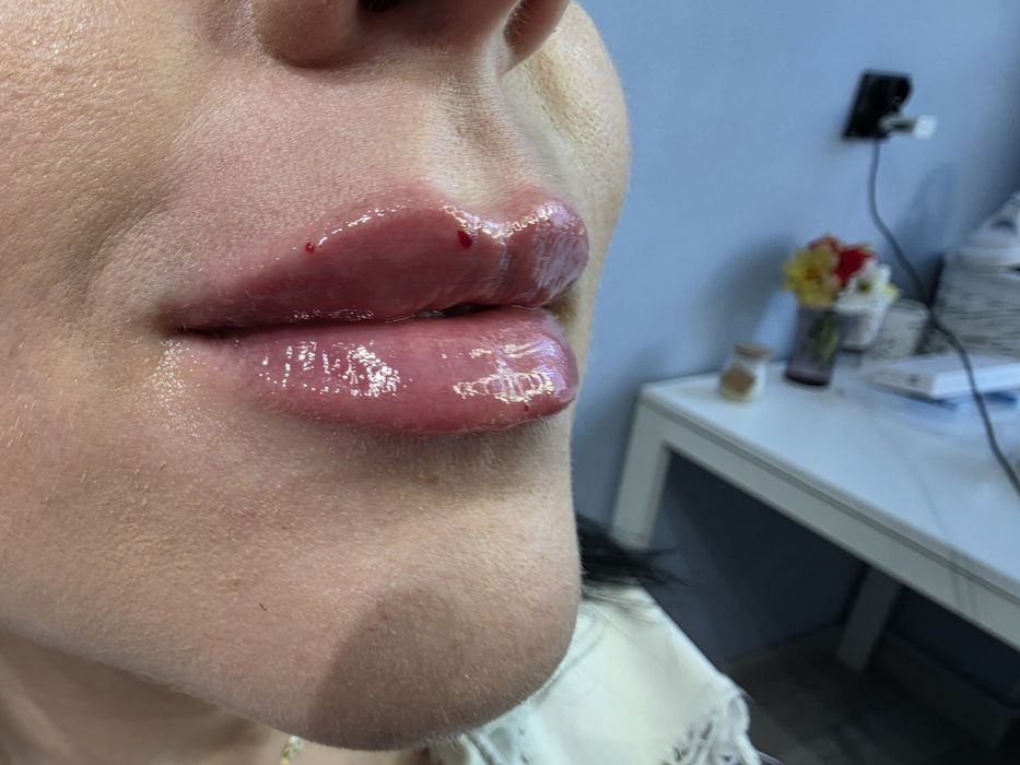 Promocja botox 1 okolica 150zł , usta 370