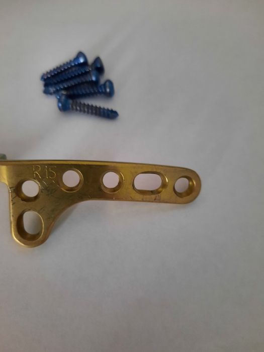 Титановая пластина на правую ключицу