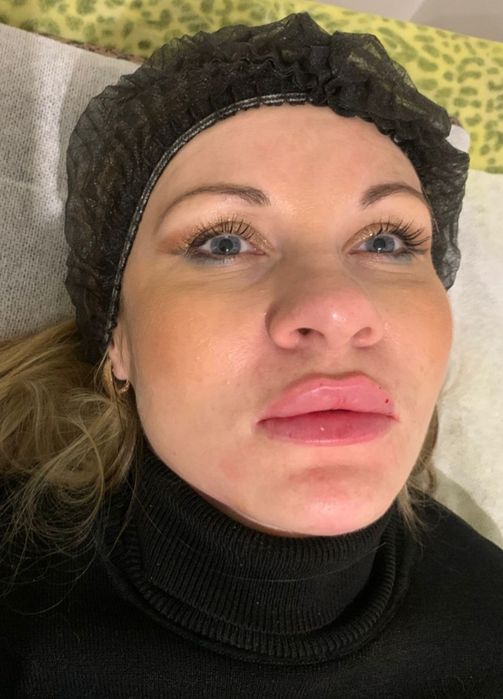 Увеличение губ ,индивидуальный подход. Сертифицированные препараты