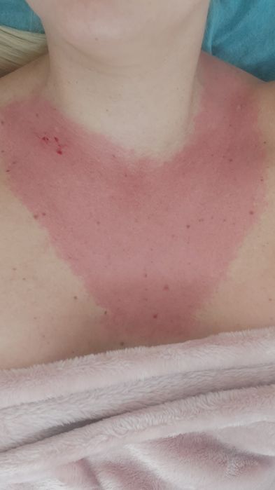 Мезотерапия, фракционная мезо, микронидлинг