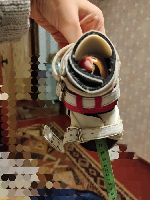 Брейсы для лечения косолапости