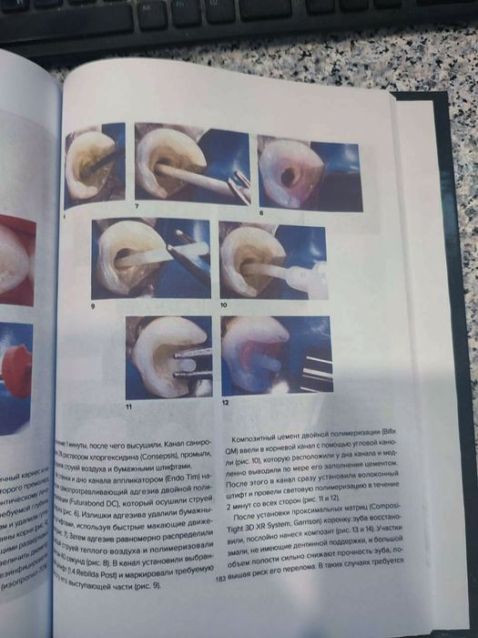 Внутрикорневые реставрации. Дуглас Терри. Стоматология. 2021