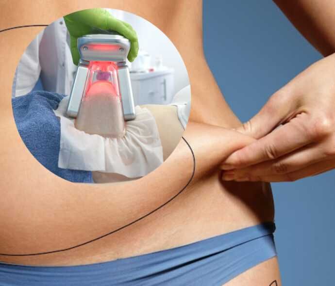 безопераційна ліпосакція кріоліполіз ціна за курс 1500грн