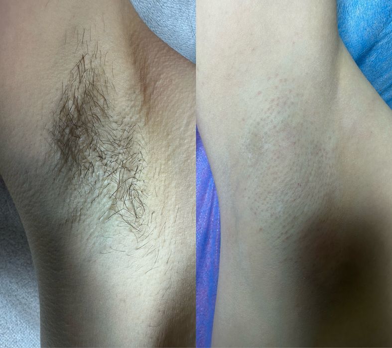 Шугаринг/електороепіляція Київ, Виноградар/Поділ)