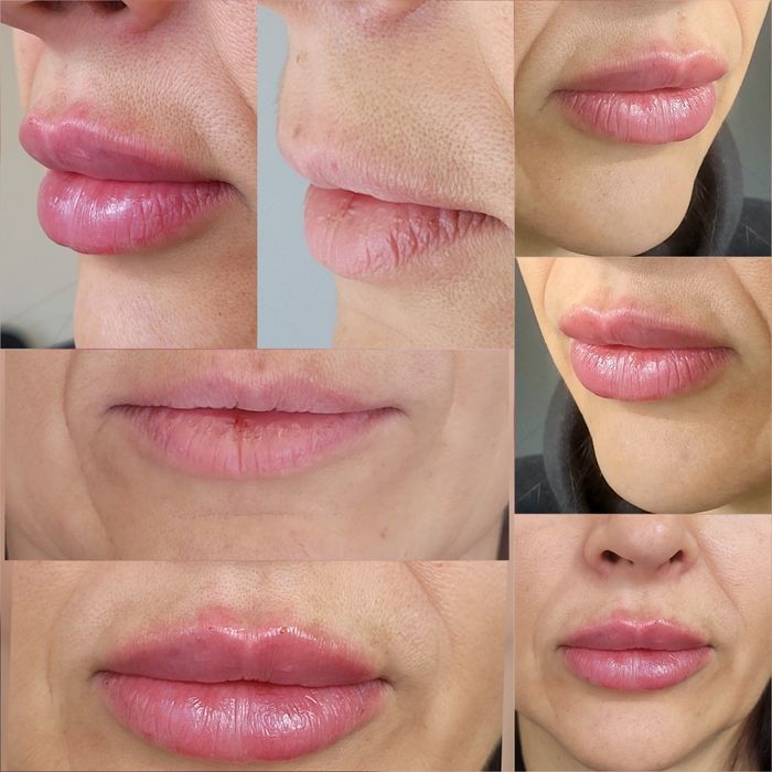 Збільшення губ КП губ Ботокс Дніпро