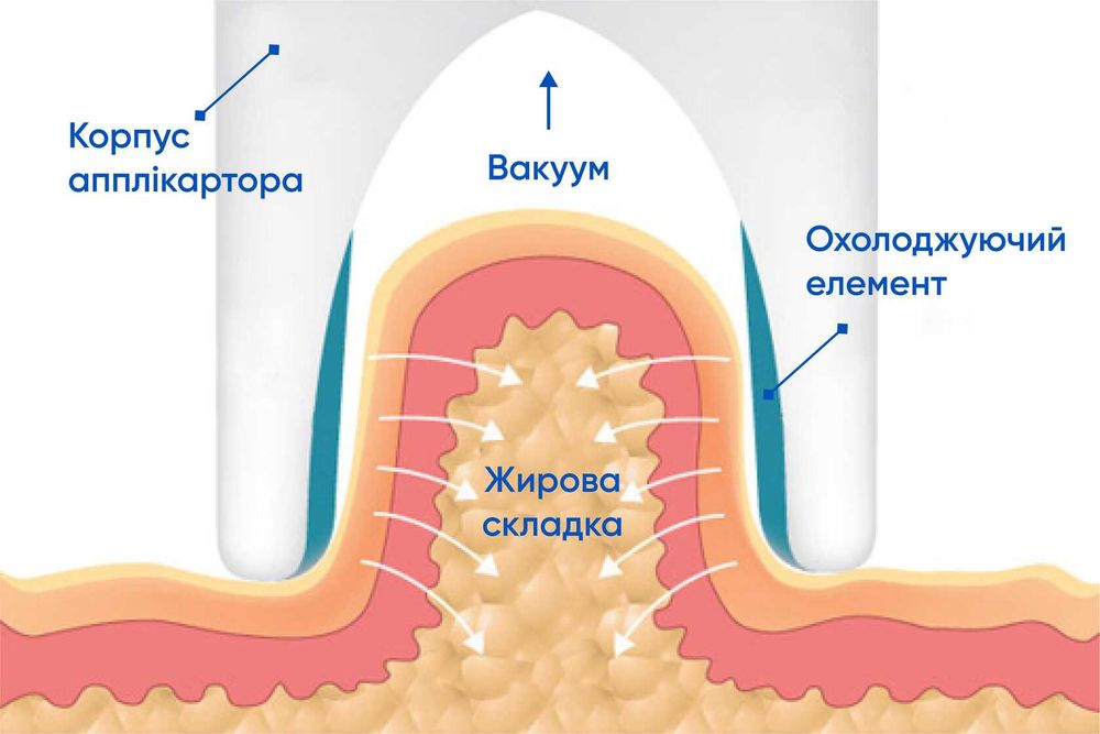 безопераційна ліпосакція кріоліполіз ціна за курс 1500грн