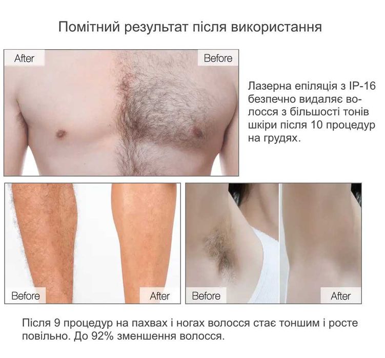 Фотоепілятор IPL (японський лазерний фотоепілятор) - для епіляції