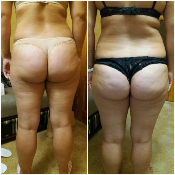 Вакумний антицелюлітний масаж