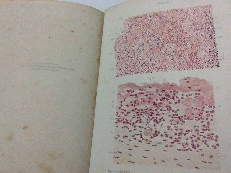 Raro exemplar. LETULLE, Maurice (1853-1929): L'Inflammation. Études anatomo-pathologiques. Rubricado pelo médico António de Padua