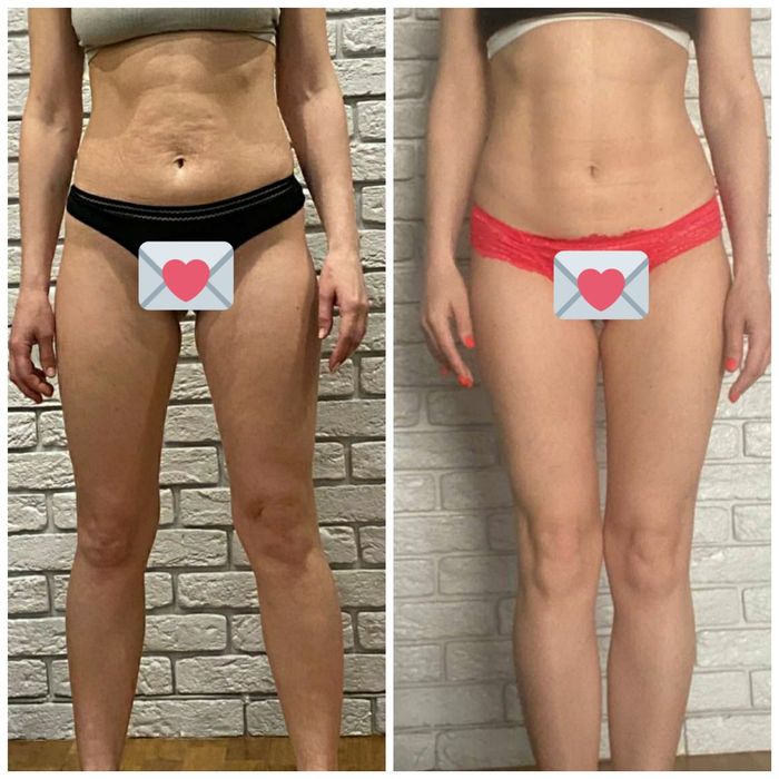 Массаж Антицеллюлитный, Классический, Лимфодренажный