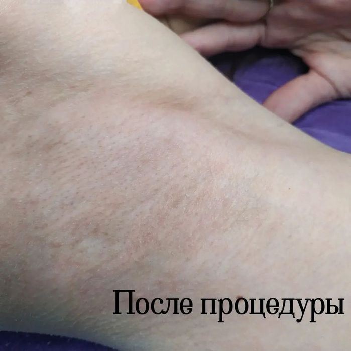 Электроэпиляция, центр города