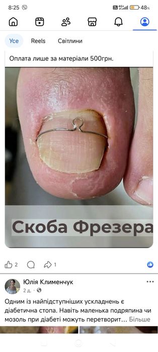 Потрібні моделі з врослими нігтями