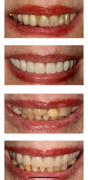 Implante dentario (355 €.)