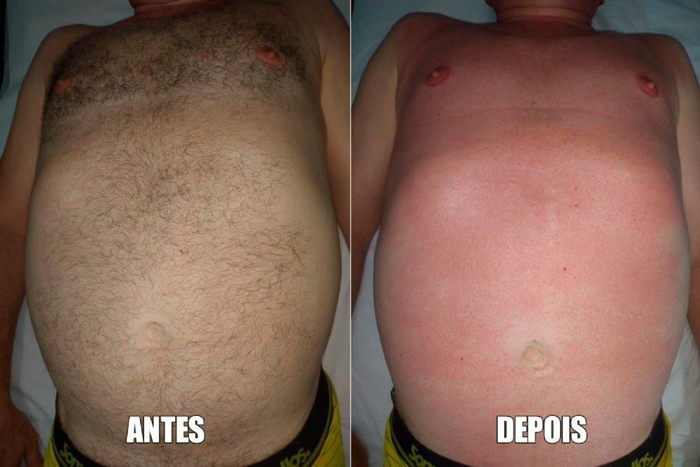 Depilação Masculina