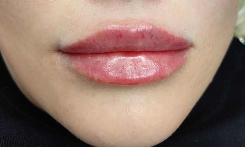 2000грнг губи Акція!Збільшення губ,контурна пластика губ,аугментація г