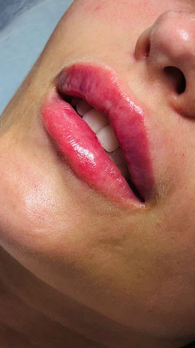 Увеличение губ , ботулинотерапия, контурная пластика