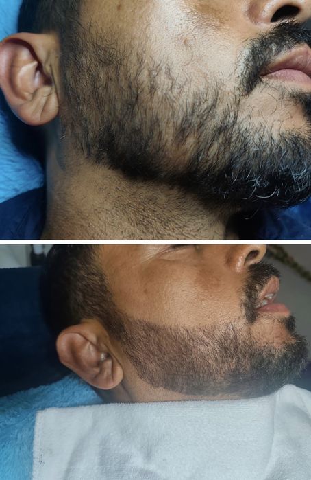 Preenchimento de barba