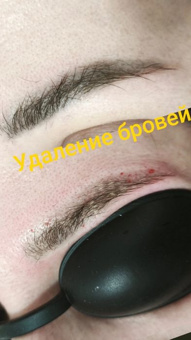 Перманентный макияж. Лазерное удаление татуажа, тату