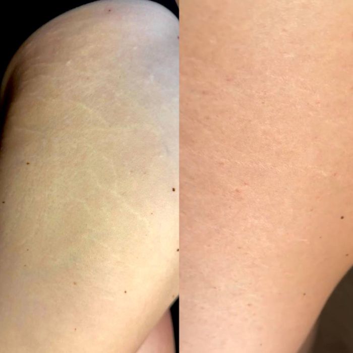 Мікронідлінг,мезотерапія обличча,рук,видалення рубців,шрамів,розтяжок