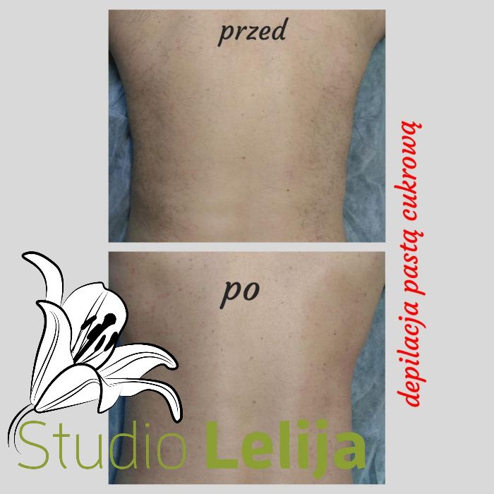 Depilacja pastą cukrową całego ciała - damska i męska.