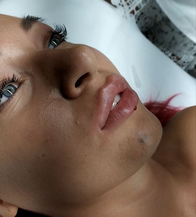 Косметолог-інʼєкціоніст Full Face | Чистка обличчя  Гідропілінг RF