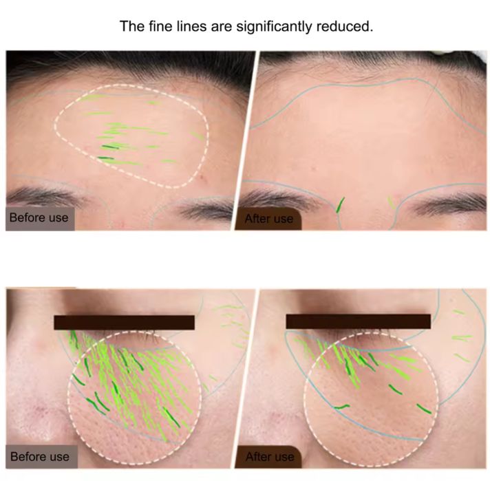 Radiofrequencia facial