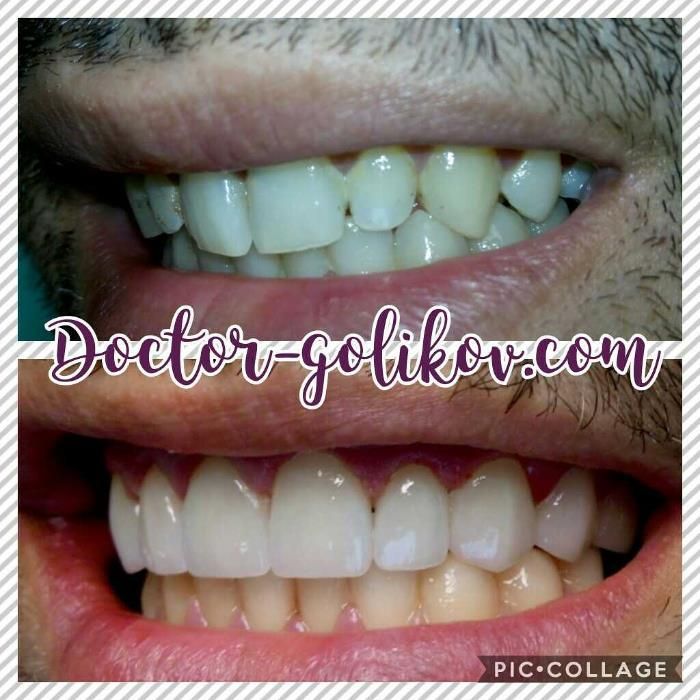 Керамічні вініри. Київ, 13500 грн . Акція! ВСЕ ВКЛЮЧЕНО!!! Е.max