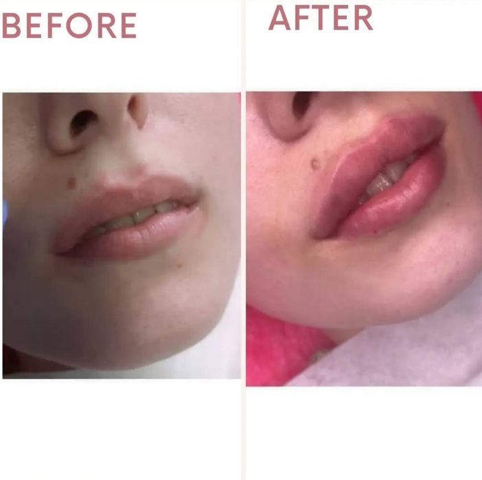збільшення губ уколи краси