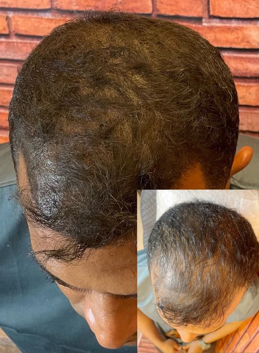 Microcapilar diretamente do Brasil para Portugal