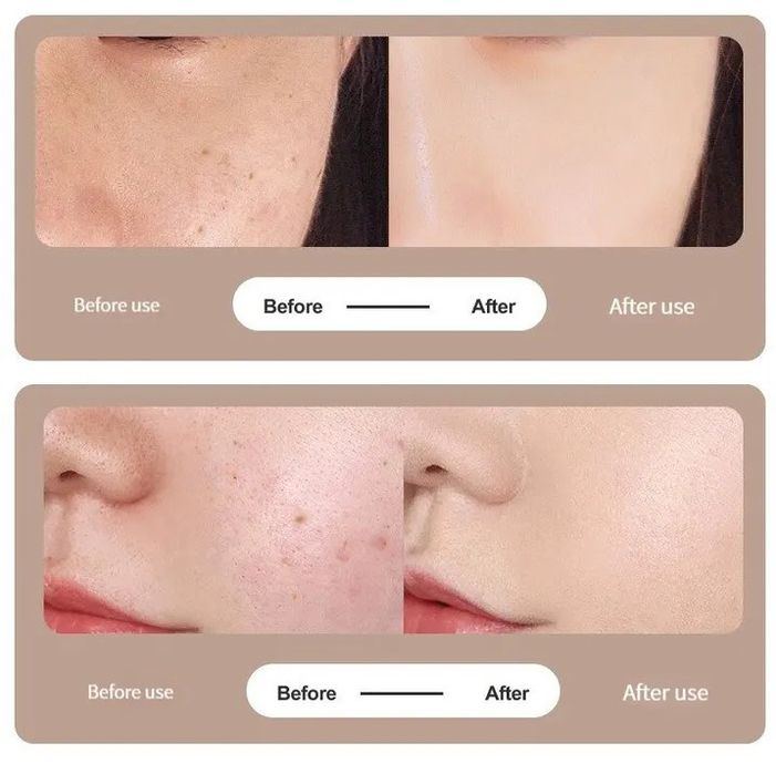 Электрокоагулятор для удаления папиллом и бородавок аппарат косметолог