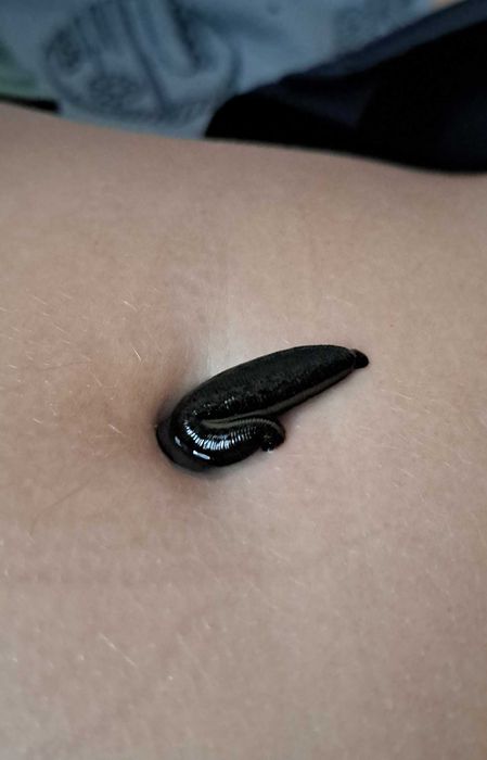 Zabieg hirudoterapii, pijawka lekarska, naturalna metoda :)