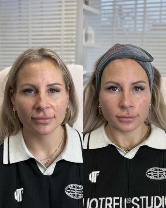 Міофасціальний масаж обличчя