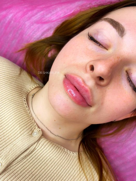 Акція! Stylage M / Контурна пластика губ /увеличение губ