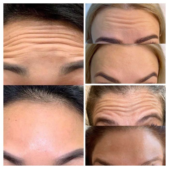 Usta/botox/mezoterapia