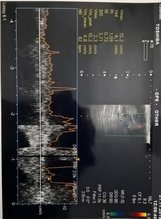 Аппарат УЗИ экспертного класса - Toshiba APLIO MX