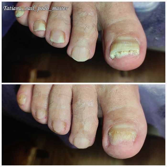 Подолог. Бородавки. Вросший ноготь. Мозоли. Грибок