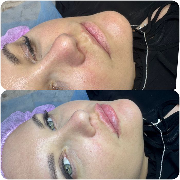 Увеличение губ и ботокс