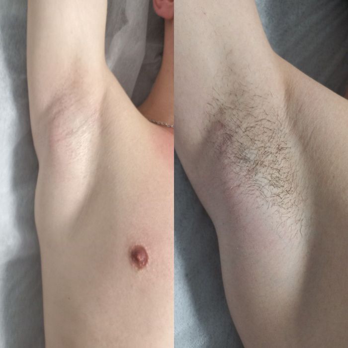 Депіляція для жінок і чоловіків, вагітних, підлітків