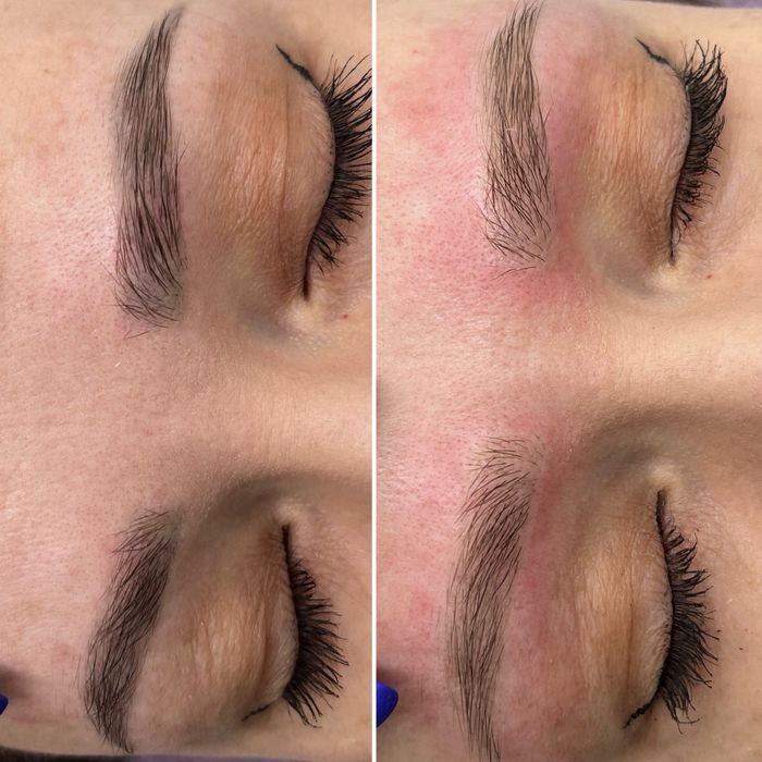 Лазерне видалення тату / татуаж / перманент