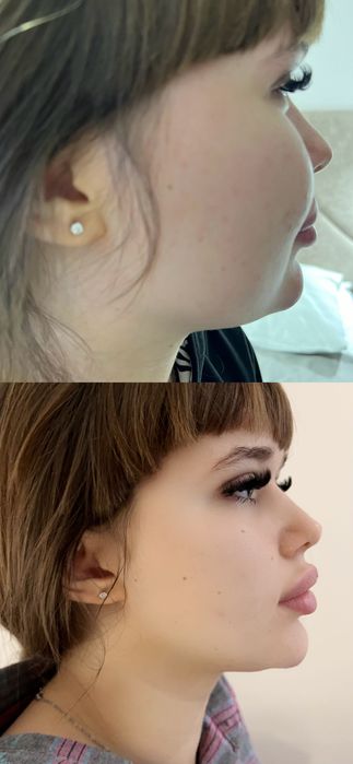 Лікування холки , корекція фігури